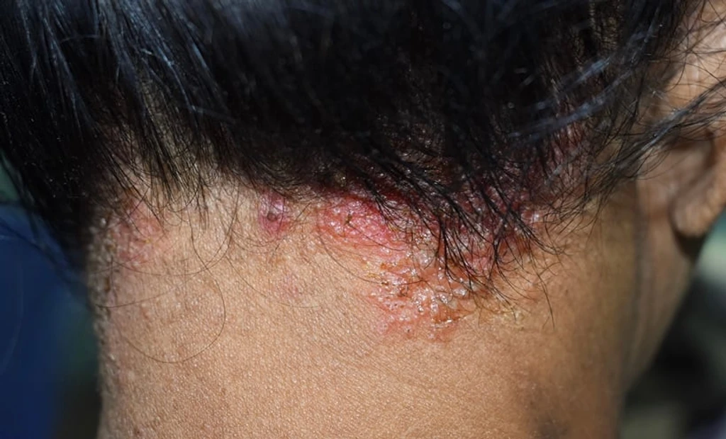 Hair Product Allergens Linked to Scalp Microbiome Changes in Dermatitis