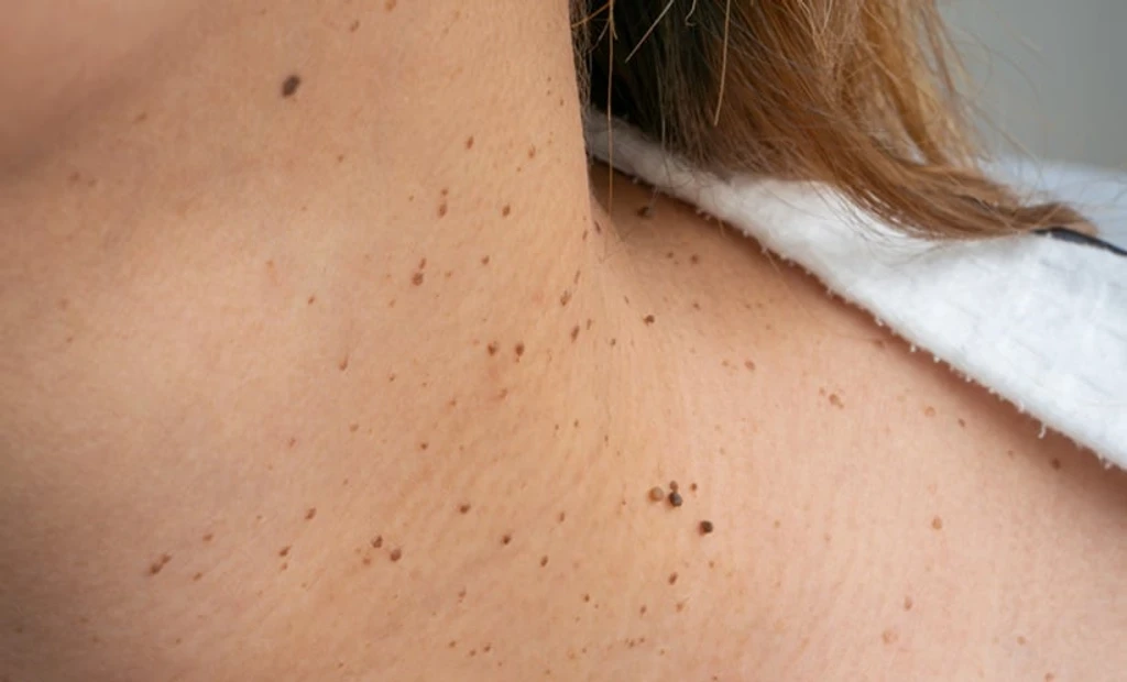 Germany’s National Skin Cancer Screening Shows No Mortality Benefit