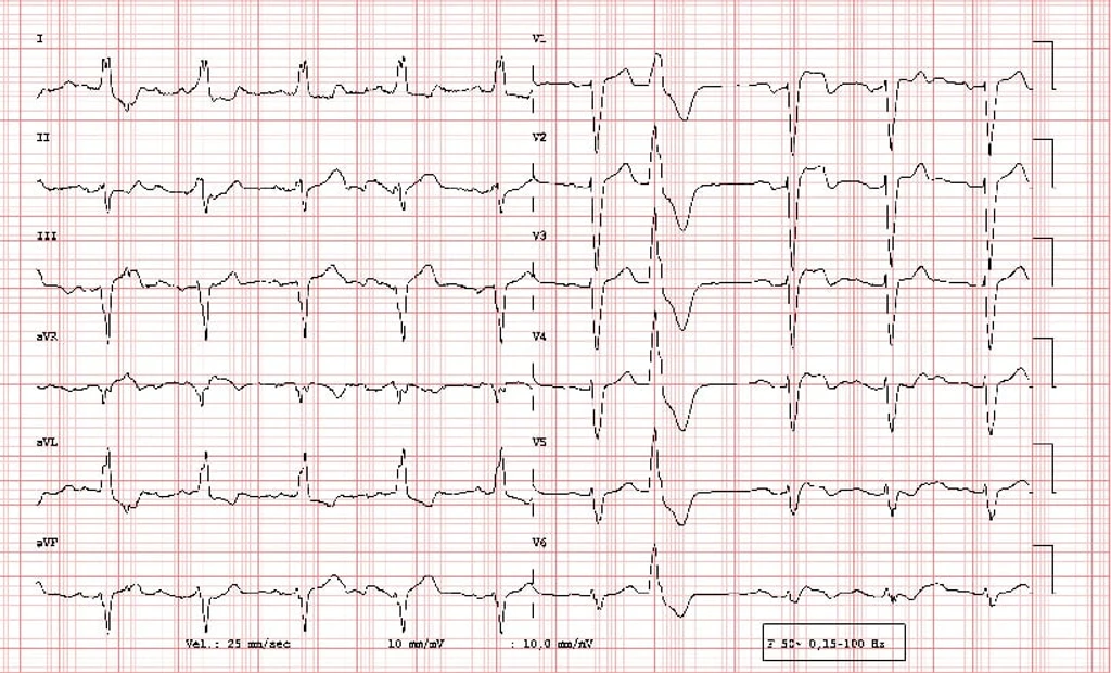 Septal Imaging Marker Flags Severe Heart Block in Myocarditis