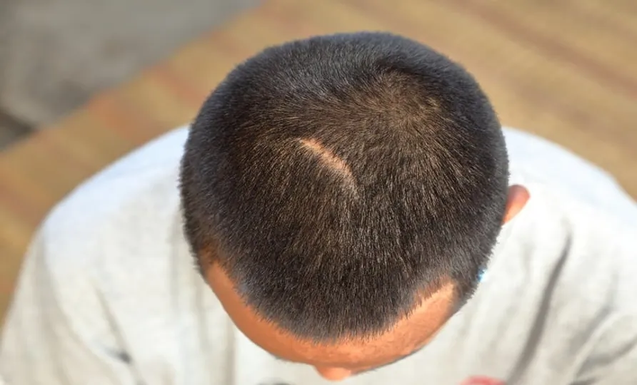 Silicone Gel: A Breakthrough for Head and Neck Scar Improvement