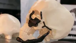 3D Printing Revolutionizes Surgical Training and Planning