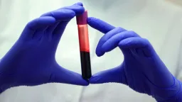 New Blood Test Detects Early Liver Scarring, Aims to Prevent Cancer