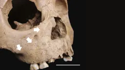 Ancient Teeth Reveal Syphilis-Like Disease in 4,000-Year-Old Vietnam Children