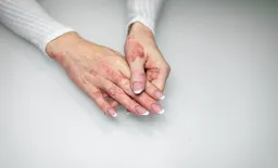 Abrocitinib Sustains Atopic Dermatitis Relief Over Two Years