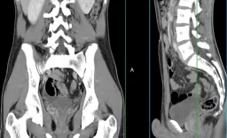 AI Accurately Detects Vertebral Fractures on CT Scans