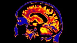 Australian Study Links Brain's 'Waste System' to Chronic Fatigue