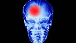 Low and High Resting Heart Rates Linked to Higher Stroke Risk