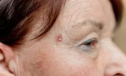 BCNS Patients Face Greater Emotional and Functional Toll Than HF-BCC