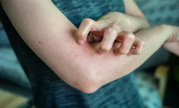 B Cells Emerge as Critical Regulators in Allergic Contact Dermatitis