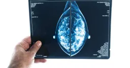 Canada's Hidden Breast Cancer Hotspots: Rural Risks and Screening Gaps