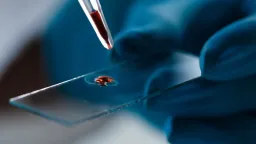 New Blood Test Predicts Alzheimer's Symptoms Years in Advance