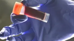 Blood Type A Linked to Higher Stroke Risk Before Age 60