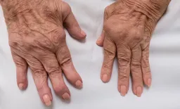 CAR-T Therapy Shows Promise in Refractory Rheumatoid Arthritis at EULAR 2026
