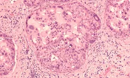 Contrast-Enhanced Mammography Boosts DCIS Detection