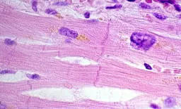 Cholesterol Pathway Disruption Identified as Key Driver in Heart Disease