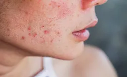 Laser vs. Microneedling for Acne Scars: New Study Compares Treatments