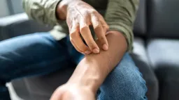 Contagious Fungal Infection Spreading: Health Officials Urge Caution
