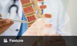How Insulin Resistance and Inflammation Silently Destroy Bone