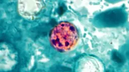 CDC Warns of Cyclosporiasis Surge as US Cases Rise