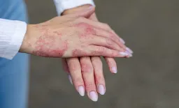 Delgocitinib Matches PUVA Therapy in Hand Eczema Treatment