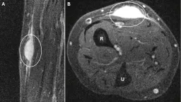 Biopsy Triggers Spontaneous Regression of Rare Arm Sarcoma