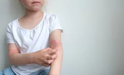 Early Atopic Dermatitis Elevates Childhood Asthma Risk
