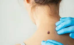 Expert Dermatologists Outperform AI Models in Real-World Skin Cancer Diagnosis