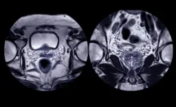 AI Boosts Prostate Cancer Biopsy Accuracy