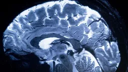 Brain 'Pacemakers' Show Promise in Rewiring Depression Circuits