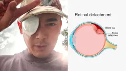 Actor Elvin Ng's Retinal Detachment: Understanding Myopia and Urgent Warning Signs