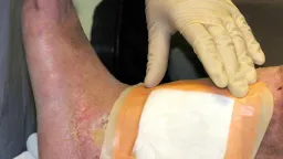 FDA Clears Second Maggot Species for Wound Therapy, Expanding Cuprina Market Lead