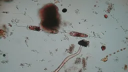 Deadly 'Flesh-Eating Bacteria' Outbreaks Surge as Oceans Warm