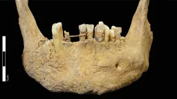 500-Year-Old Gold Dental Bridge Found in Scotland Is Earliest Known Oral Care of Its Kind
