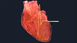 GLP-1 Drugs Show Heart Attack Recovery Potential