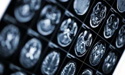GLP-1RAs Linked to Lower Death Risk in Brain Cancer, Diabetes Patients