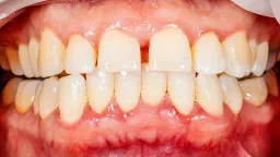 Fasting-Mimicking Diet Cuts Gum Disease Inflammation in Study
