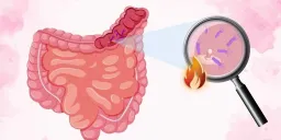 The Link Between Your Gut Microbiome and Colorectal Cancer Risk