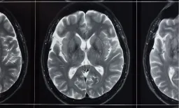 New MRI Tech Offers Sharper Brain Imaging