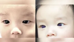Infant's Eyes Turn Blue After COVID Antiviral Treatment