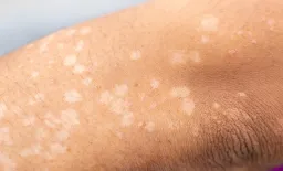 Lupus Treatment Shifts to Precision Immunotherapy