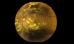 Metformin Linked to 37% Lower Risk of Macular Degeneration in Diabetics