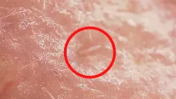 Facial Mites Are Evolving Into Human Symbionts