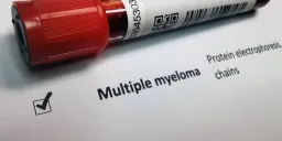 Multiple Myeloma: Early Signs and Treatment Advances