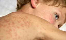 London Measles Crisis Sparks Vaccination Urgency