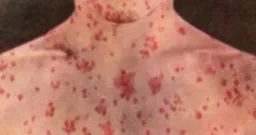 Measles Exposure Alert Issued for Pearson Airport Travelers