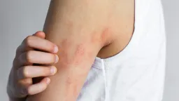 New Eczema Treatments Offer Hope But Remain Out of Reach for Many
