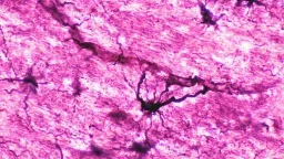 Two Patients in Long-Term Remission After Immune 'Reset' for Aggressive Autoimmune Disease