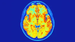 New Genetic Disorder Linked to RNU2-2 Gene Discovered