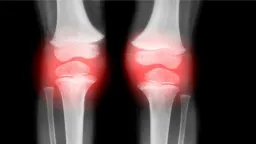 Single Injection Reverses Osteoarthritis in Animal Study