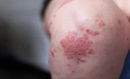 New Protein Target PA2G4 Shows Promise for Psoriasis Treatment